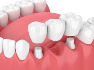 Restore your smile with high-quality dental implants at Trafalgar Village Dental