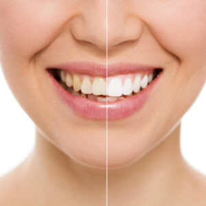 teeth whitening reveal before and after