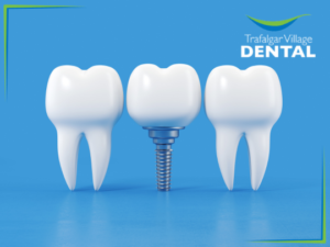 dental implants