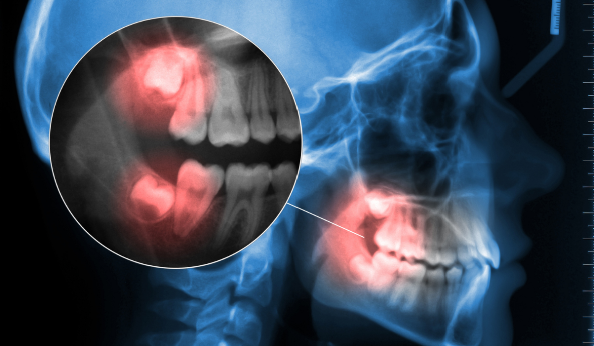 Wisdom teeth extractions consultation at Trafalgar Village Dental