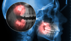 Wisdom teeth extractions consultation at Trafalgar Village Dental