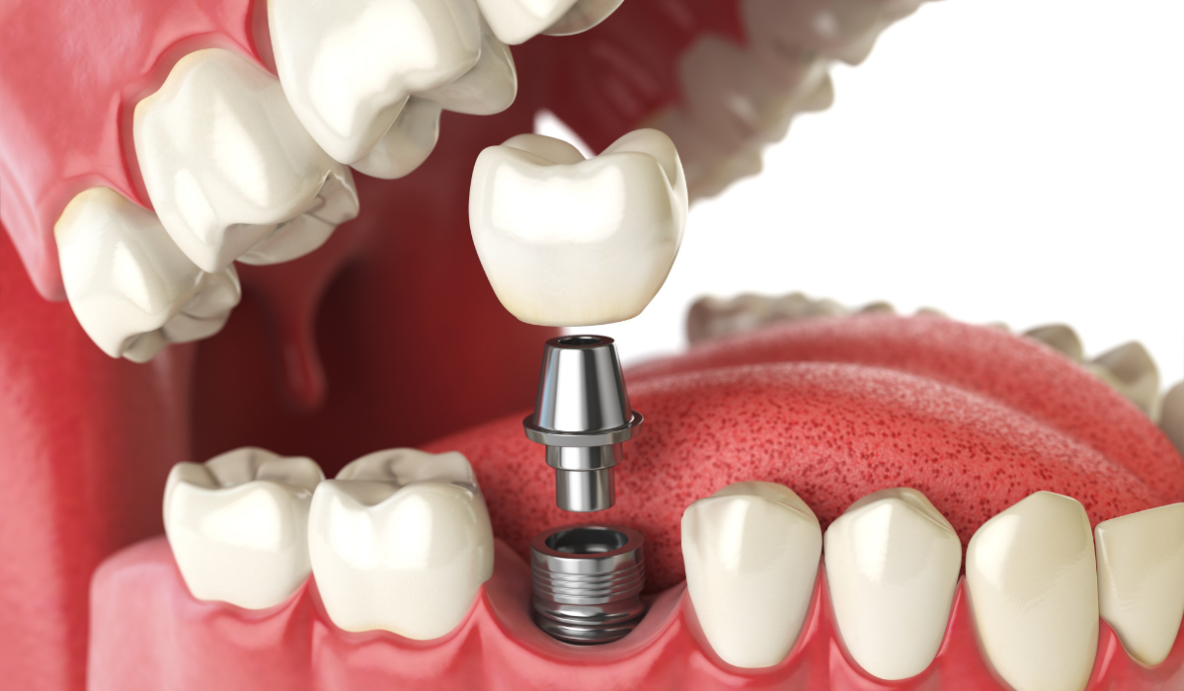Dental implants treatment options comparison at Trafalgar Village Dental