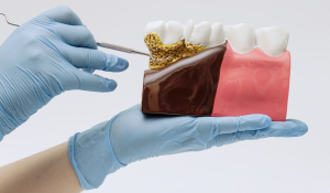 Dentist in Oakville providing periodontal therapy for gum disease at Trafalgar Village Dental